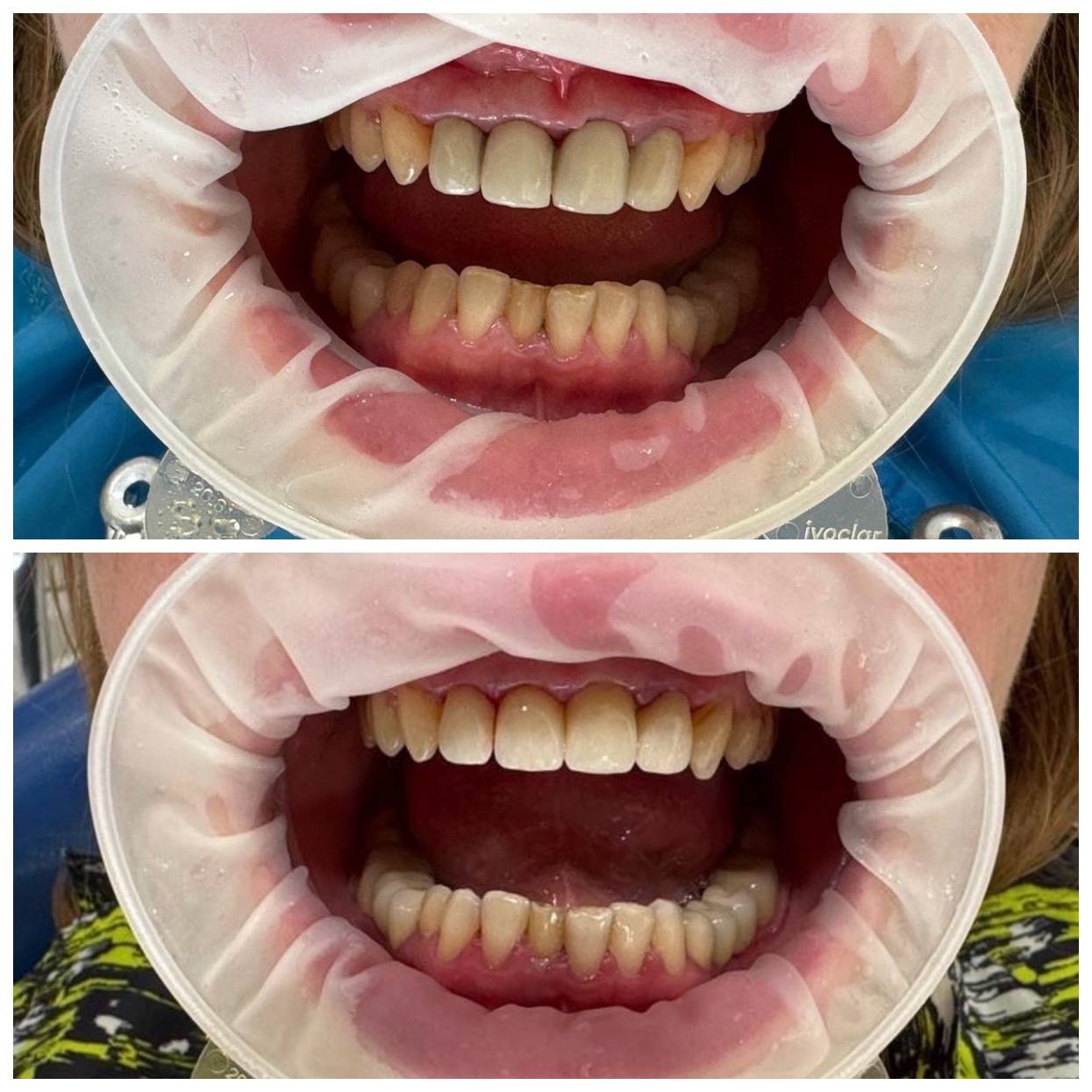 Что лучше металлокерамика или диоксид циркония?