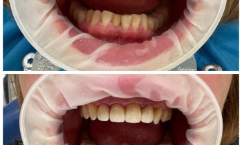 Что лучше металлокерамика или диоксид циркония?