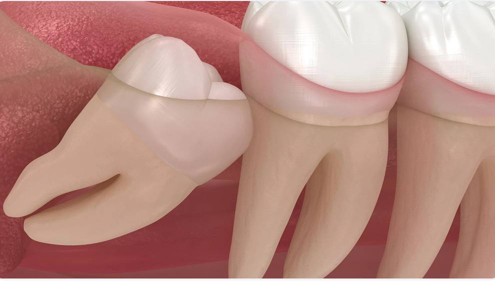 Почему иногда зубы мудрости удаляют не в поликлинике, а в стационаре ?