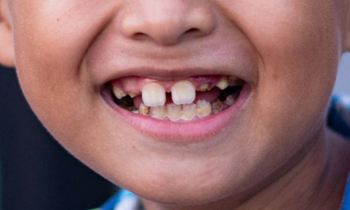 Что делать если у ребенка передние верхние зубы в 7 лет растут не рядом, а на расстоянии? Помню, что мне их связывали ниткой, чтобы были вместе. Так можно делать?