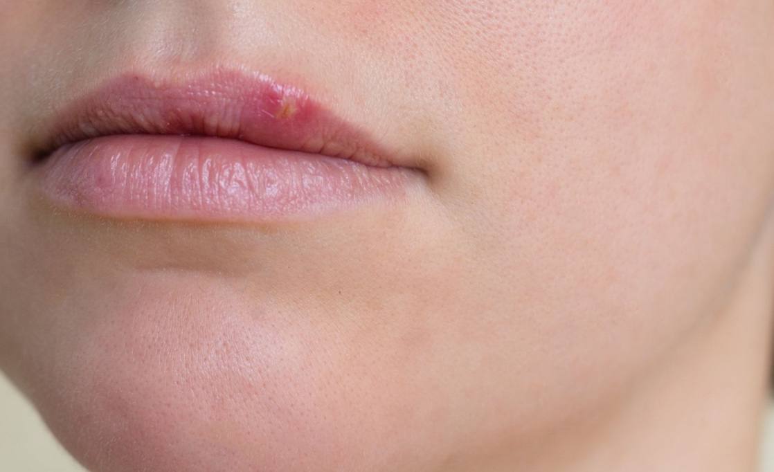 Можно ли к стоматологу с герпесом на губе?