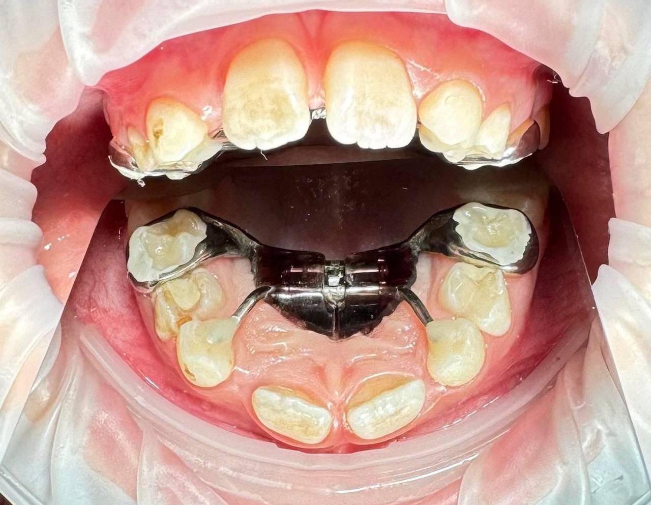 Аппарат Марко Роса